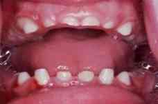 Стертые верхние зубы взрослого человека Скрип зубами во сне у ребенка. Стертые зубы измененный прикус